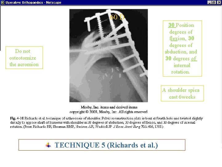 60 D 30 Position degrees of flexion, 30 degrees of abduction, and 30 degrees