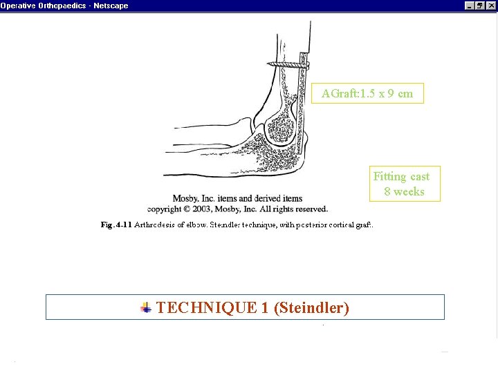 AGraft: 1. 5 x 9 cm Fitting cast 8 weeks TECHNIQUE 1 (Steindler) ARTHRODESIS