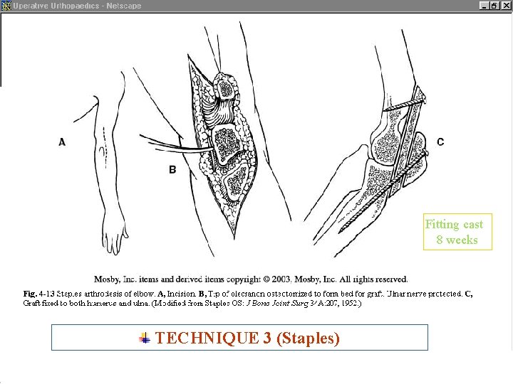 Fitting cast 8 weeks TECHNIQUE 3 (Staples) ARTHRODESIS 24 