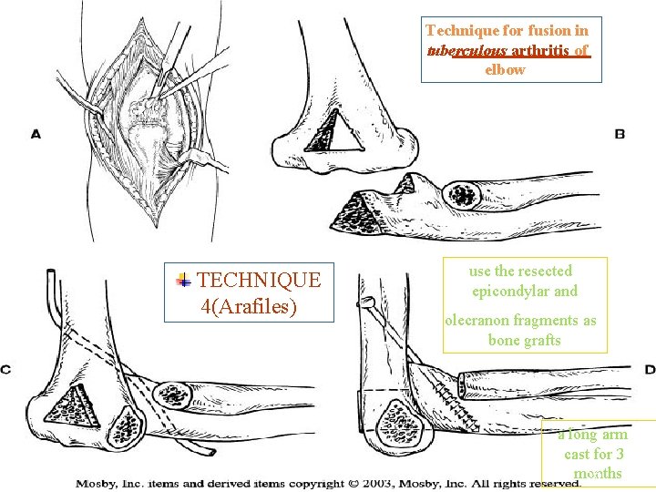 Technique for fusion in tuberculous arthritis of elbow. TECHNIQUE 4(Arafiles) ARTHRODESIS use the resected