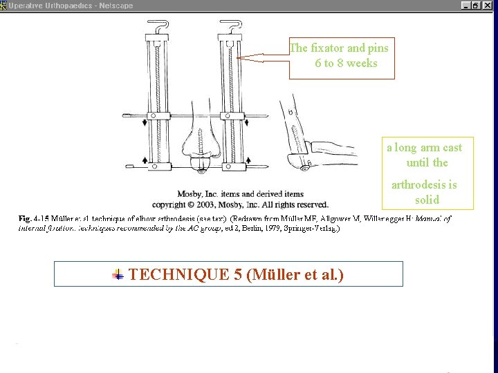 The fixator and pins 6 to 8 weeks a long arm cast until the