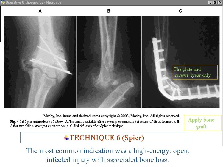 The plate and screws 1 year only Apply bone graft TECHNIQUE 6 (Spier) The
