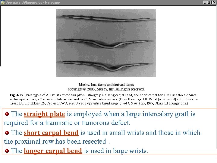 The straight plate is employed when a large intercalary graft is required for a