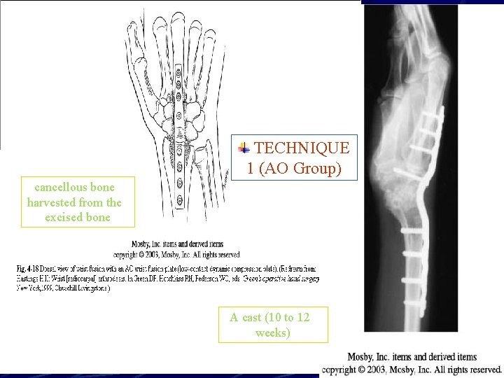 TECHNIQUE 1 (AO Group) cancellous bone harvested from the excised bone A cast (10