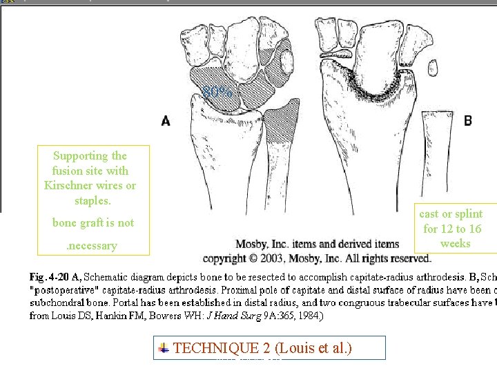 80% Supporting the fusion site with Kirschner wires or staples. cast or splint for