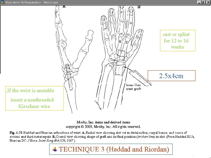 cast or splint for 12 to 16 weeks 2. 5 x 4 cm ,