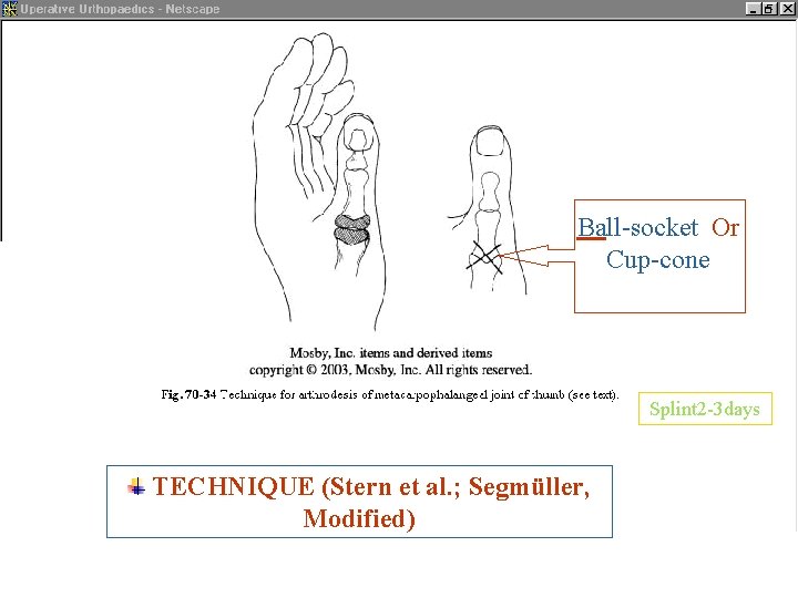 Ball-socket Or Cup-cone Splint 2 -3 days TECHNIQUE (Stern et al. ; Segmüller, Modified)