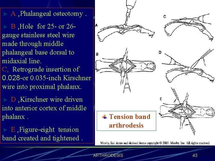 A , Phalangeal osteotomy. B , Hole for 25 - or 26 gauge stainless