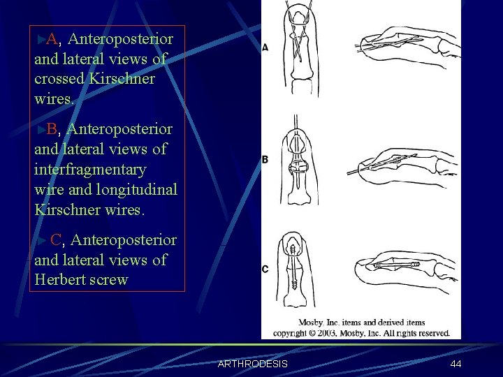 A, Anteroposterior and lateral views of crossed Kirschner wires. B, Anteroposterior and lateral views