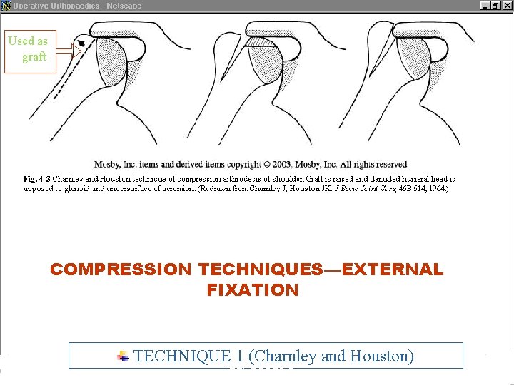 Used as graft COMPRESSION TECHNIQUES—EXTERNAL FIXATION TECHNIQUE 1 (Charnley and Houston) ARTHRODESIS 9 