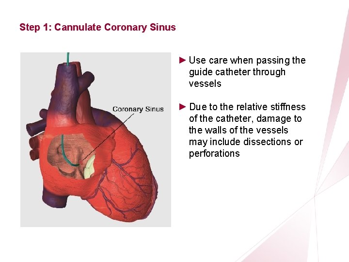 CRT Essentials Program Left-Heart Lead Implant Procedure Step 1: Cannulate Coronary Sinus ► Use