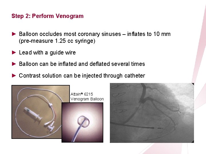 CRT Essentials Program Left-Heart Lead Implant Procedure Step 2: Perform Venogram ► Balloon occludes