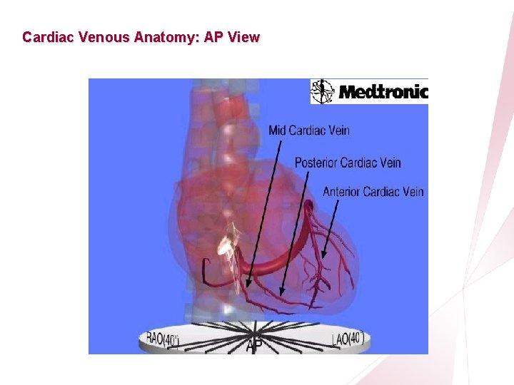 CRT Essentials Program Cardiac Venous Anatomy: AP View Left-Heart Lead Implant Procedure 