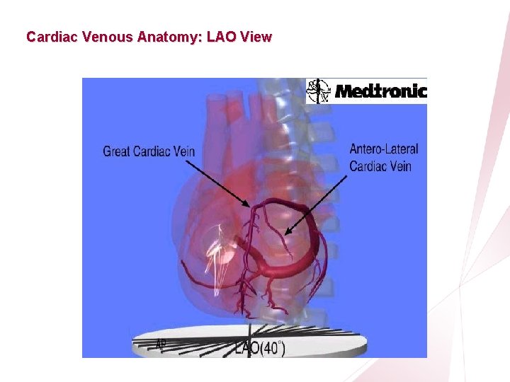 CRT Essentials Program Cardiac Venous Anatomy: LAO View Left-Heart Lead Implant Procedure 