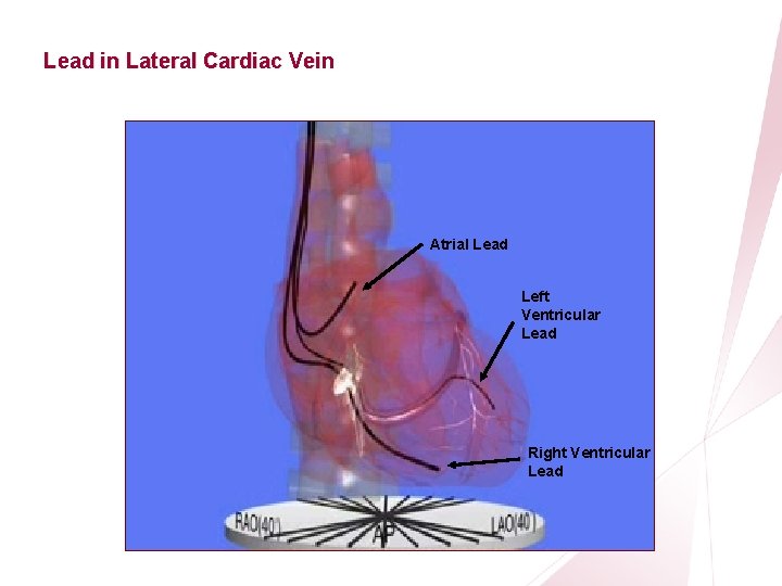 CRT Essentials Program Left-Heart Lead Implant Procedure Lead in Lateral Cardiac Vein Atrial Lead