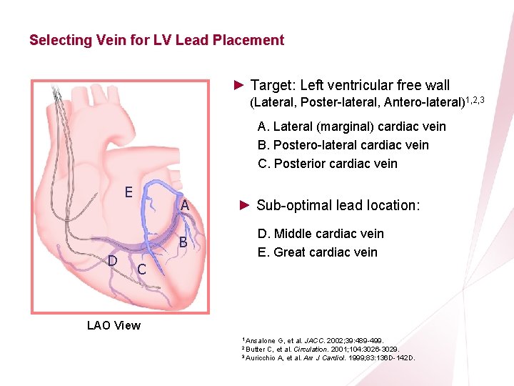 CRT Essentials Program Left-Heart Lead Implant Procedure Selecting Vein for LV Lead Placement ►