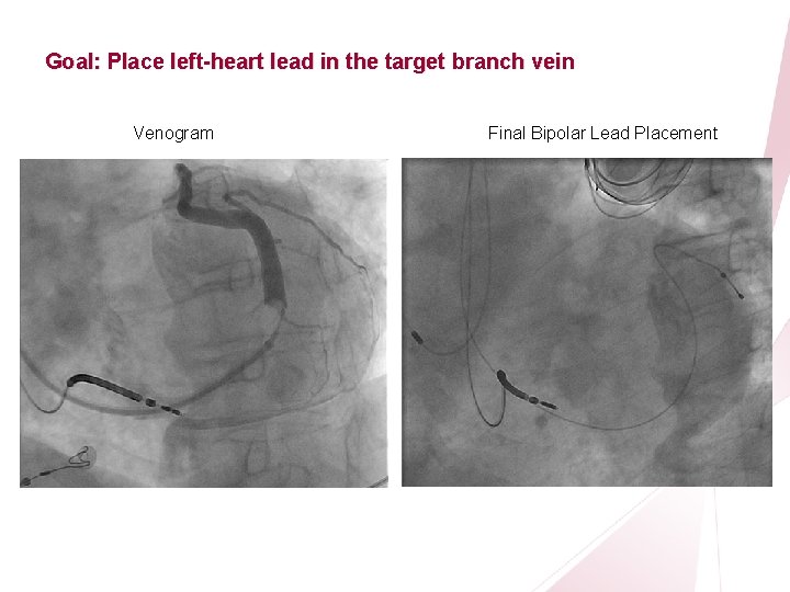 CRT Essentials Program Left-Heart Lead Implant Procedure Goal: Place left-heart lead in the target