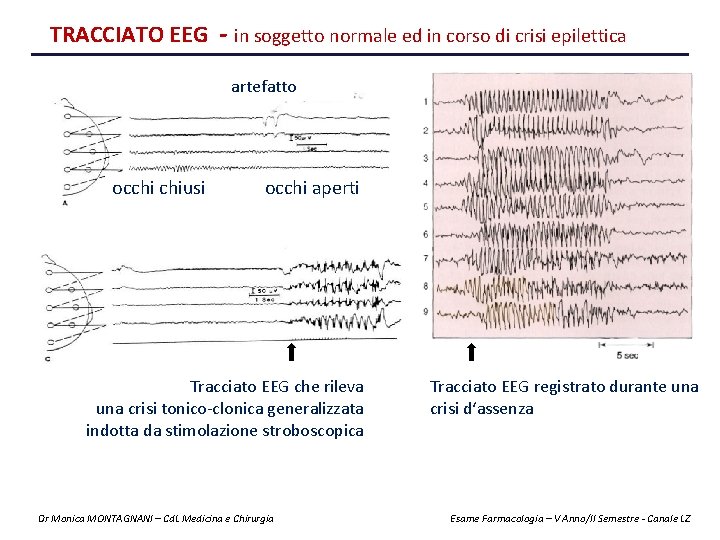 TRACCIATO EEG - in soggetto normale ed in corso di crisi epilettica artefatto occhi