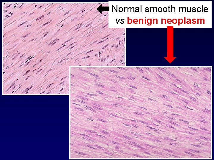 Normal smooth muscle vs benign neoplasm 