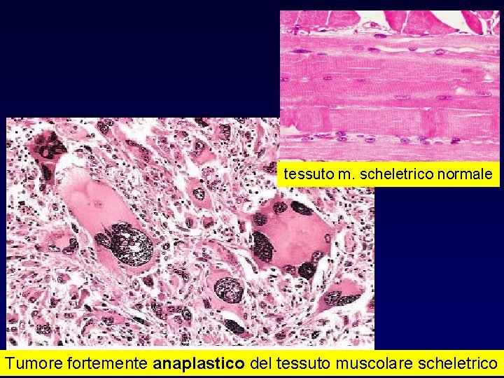tessuto m. scheletrico normale Tumore fortemente anaplastico del tessuto muscolare scheletrico 