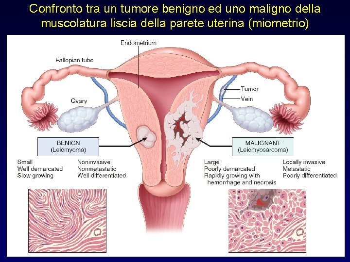 Confronto tra un tumore benigno ed uno maligno della muscolatura liscia della parete uterina