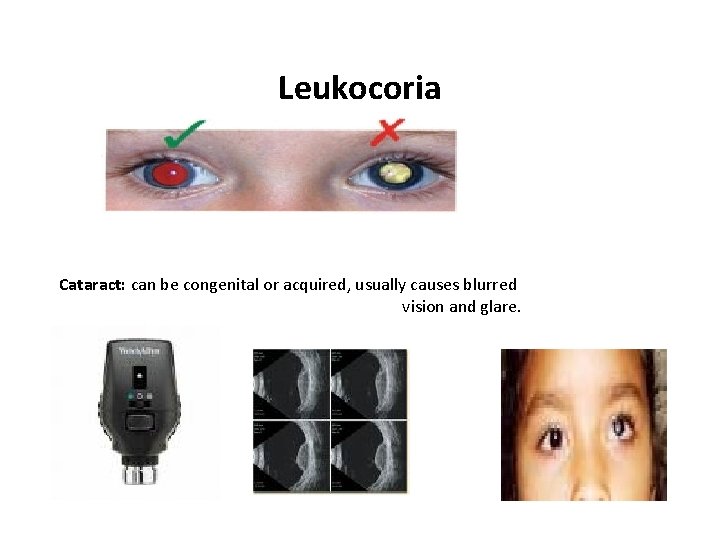 Leukocoria Cataract: can be congenital or acquired, usually causes blurred vision and glare. 