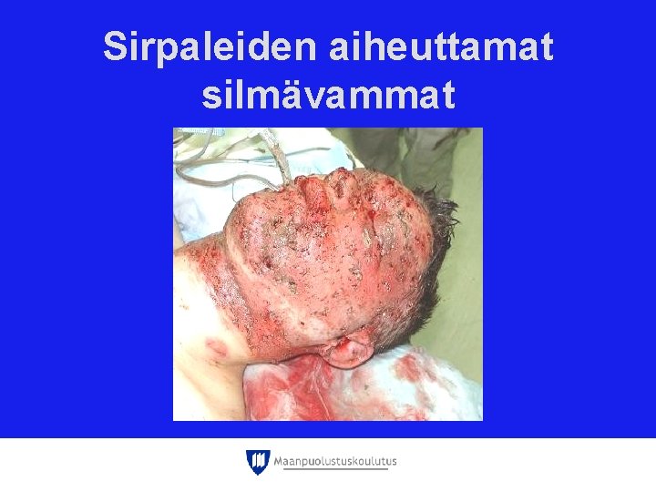 Sirpaleiden aiheuttamat silmävammat Sirpaleiden aiheuttamat silmävammat