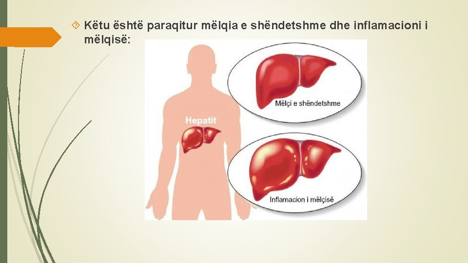  Këtu është paraqitur mëlqia e shëndetshme dhe inflamacioni i mëlqisë: 