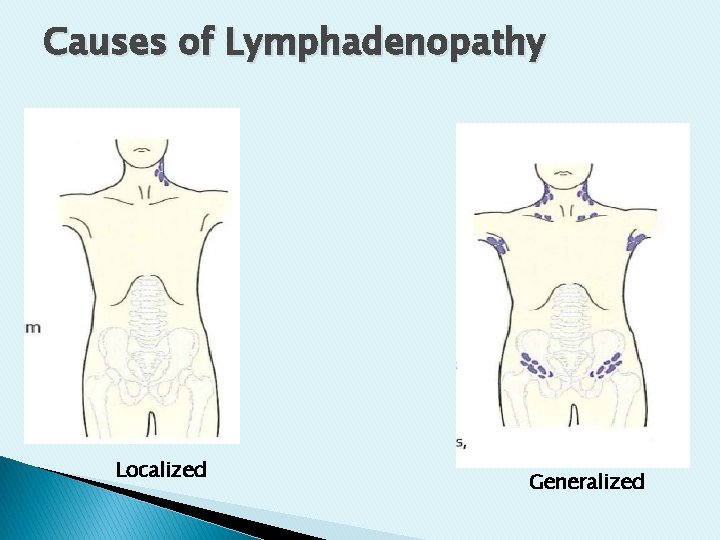 Causes of Lymphadenopathy Localized Generalized Causes of Lymphadenopathy Localized Generalized