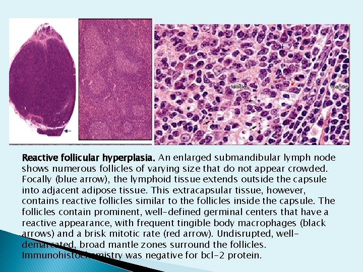 Reactive follicular hyperplasia. An enlarged submandibular lymph node shows numerous follicles of varying size Reactive follicular hyperplasia. An enlarged submandibular lymph node shows numerous follicles of varying size