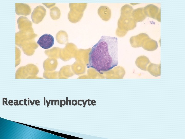 Reactive lymphocyte Reactive lymphocyte