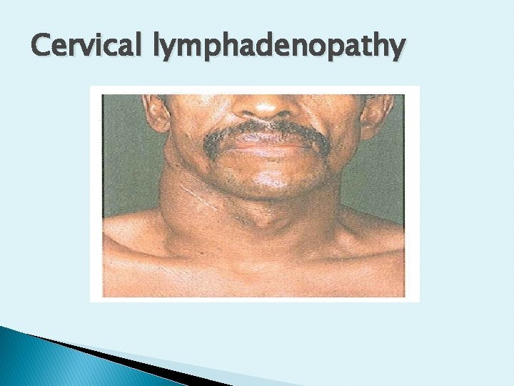 Cervical lymphadenopathy Cervical lymphadenopathy