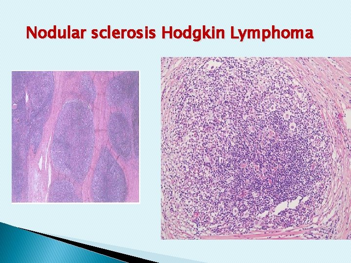 Nodular sclerosis Hodgkin Lymphoma Nodular sclerosis Hodgkin Lymphoma