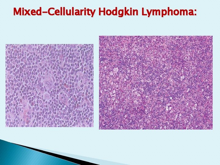 Mixed-Cellularity Hodgkin Lymphoma: Mixed-Cellularity Hodgkin Lymphoma: