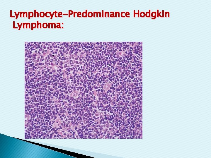 Lymphocyte-Predominance Hodgkin Lymphoma: Lymphocyte-Predominance Hodgkin Lymphoma: