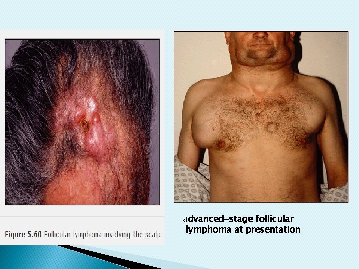 advanced-stage follicular lymphoma at presentation advanced-stage follicular lymphoma at presentation