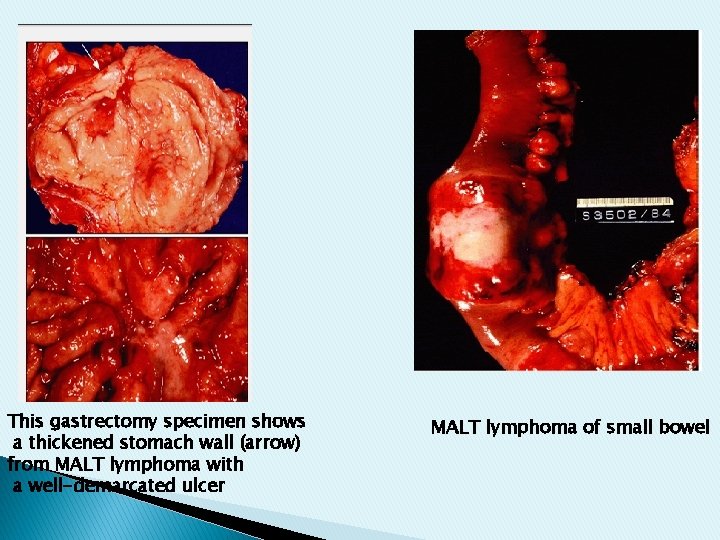This gastrectomy specimen shows a thickened stomach wall (arrow) from MALT lymphoma with a This gastrectomy specimen shows a thickened stomach wall (arrow) from MALT lymphoma with a