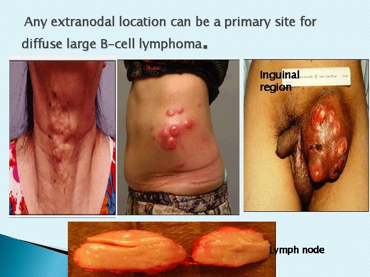 Any extranodal location can be a primary site for . diffuse large B-cell lymphoma Any extranodal location can be a primary site for . diffuse large B-cell lymphoma