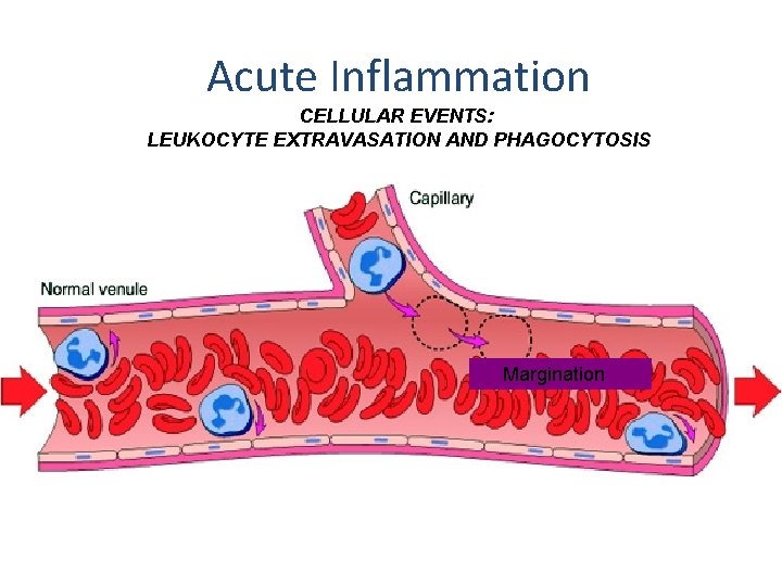 Acute Inflammation CELLULAR EVENTS: LEUKOCYTE EXTRAVASATION AND PHAGOCYTOSIS Margination 