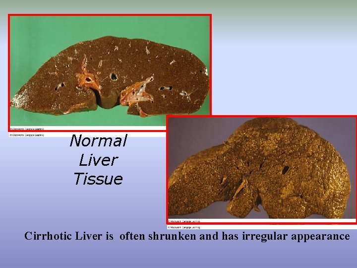 Normal Liver Tissue Cirrhotic Liver is often shrunken and has irregular appearance 