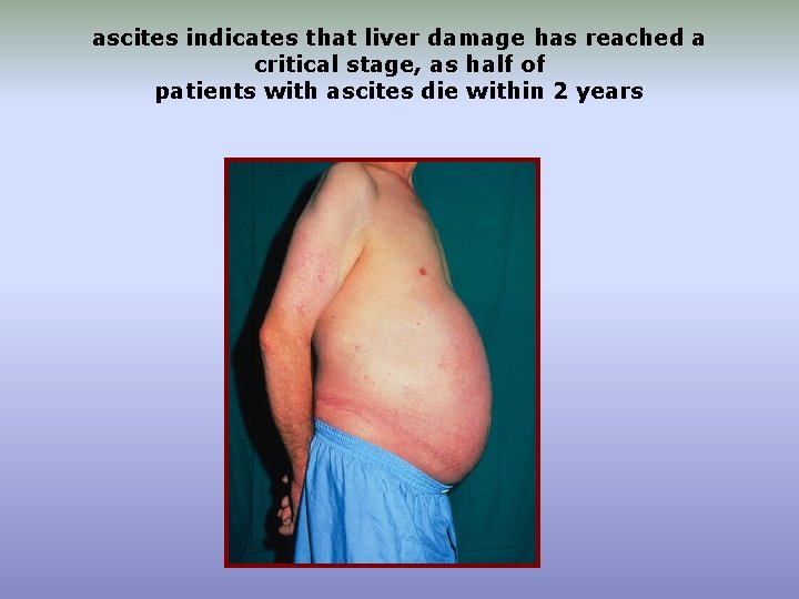 ascites indicates that liver damage has reached a critical stage, as half of patients