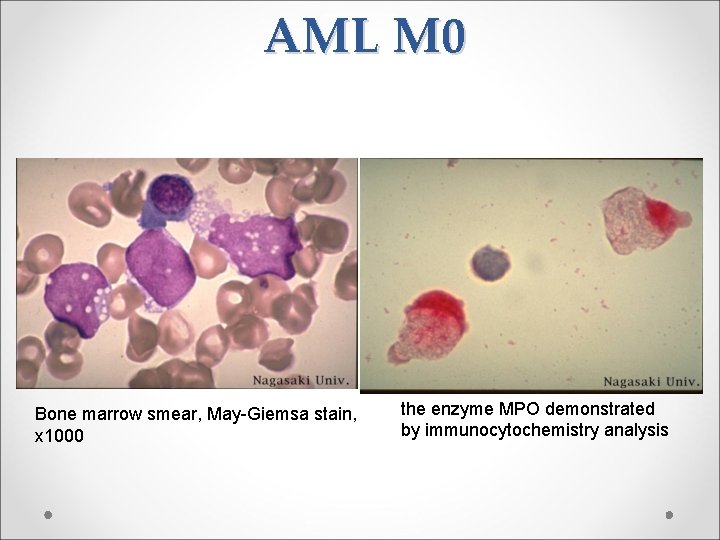 AML M 0 Bone marrow smear, May-Giemsa stain, x 1000 the enzyme MPO demonstrated