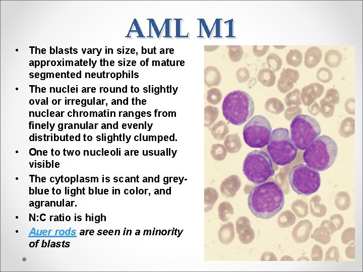 AML M 1 • The blasts vary in size, but are approximately the size