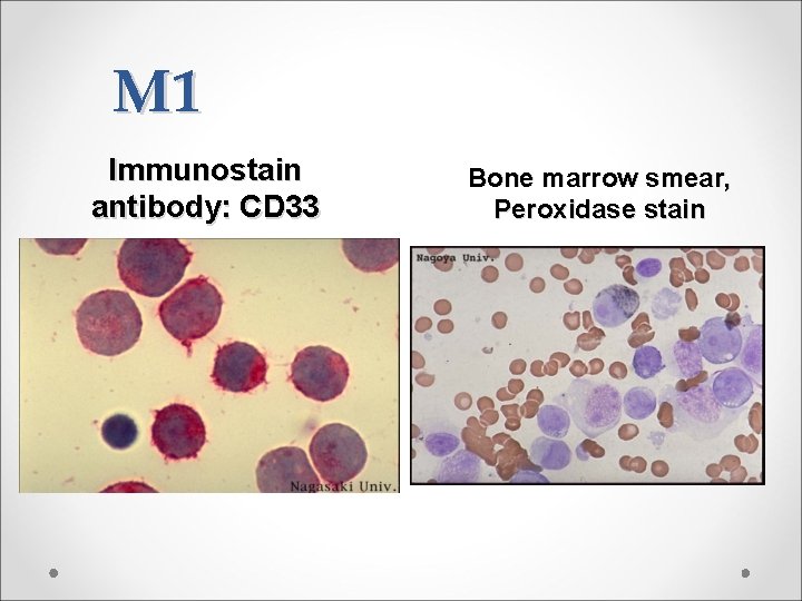 M 1 Immunostain antibody: CD 33 Bone marrow smear, Peroxidase stain 