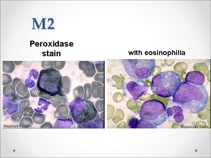 M 2 Peroxidase stain with eosinophilia 