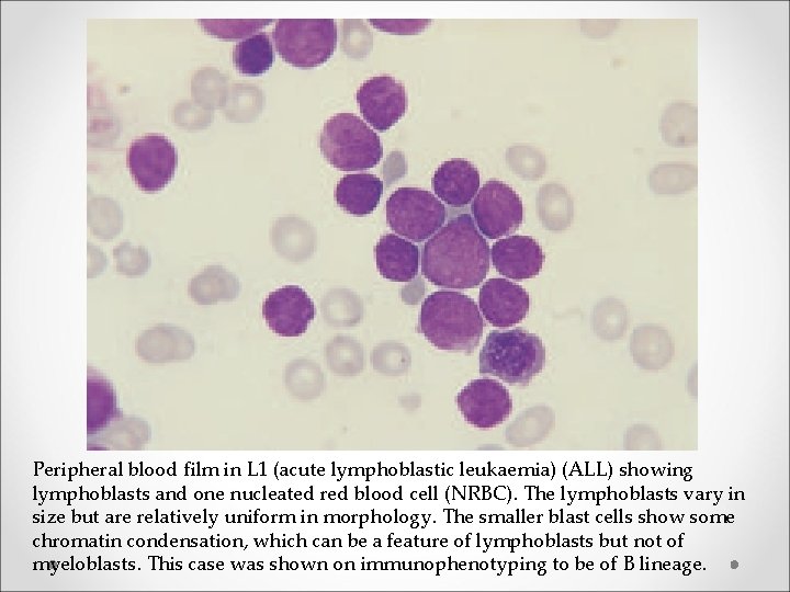 Peripheral blood film in L 1 (acute lymphoblastic leukaemia) (ALL) showing lymphoblasts and one