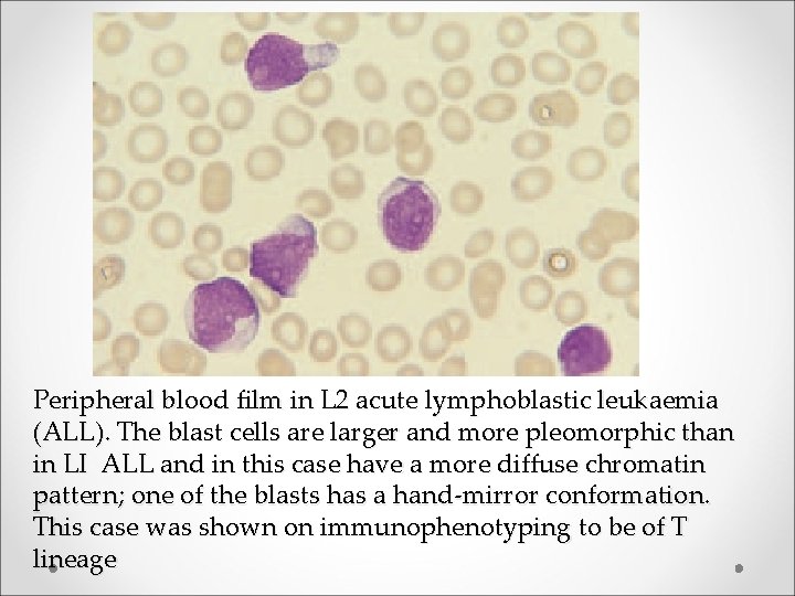 Peripheral blood film in L 2 acute lymphoblastic leukaemia (ALL). The blast cells are