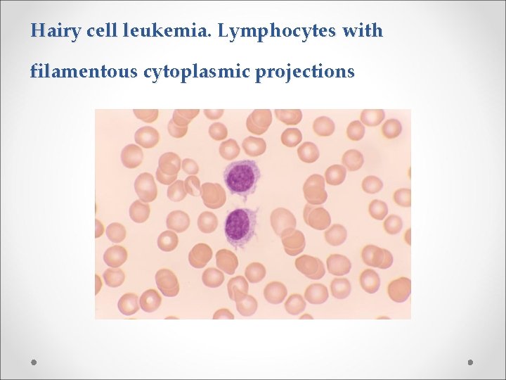 Hairy cell leukemia. Lymphocytes with filamentous cytoplasmic projections 