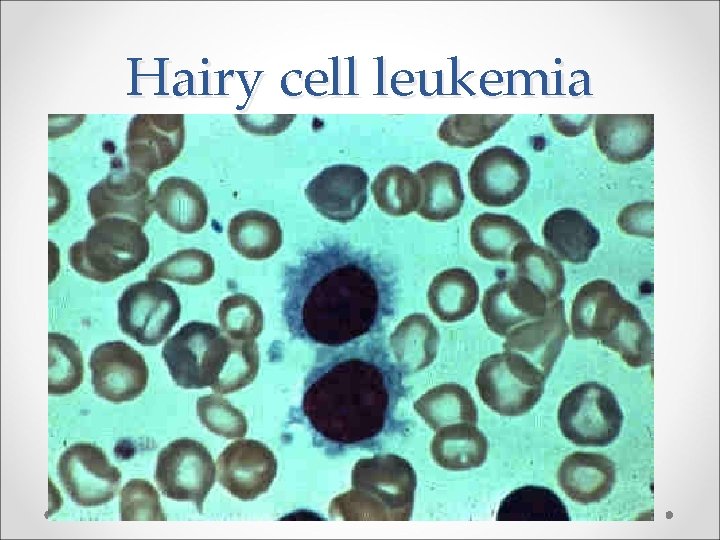 Hairy cell leukemia 