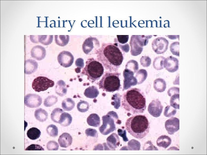 Hairy cell leukemia 
